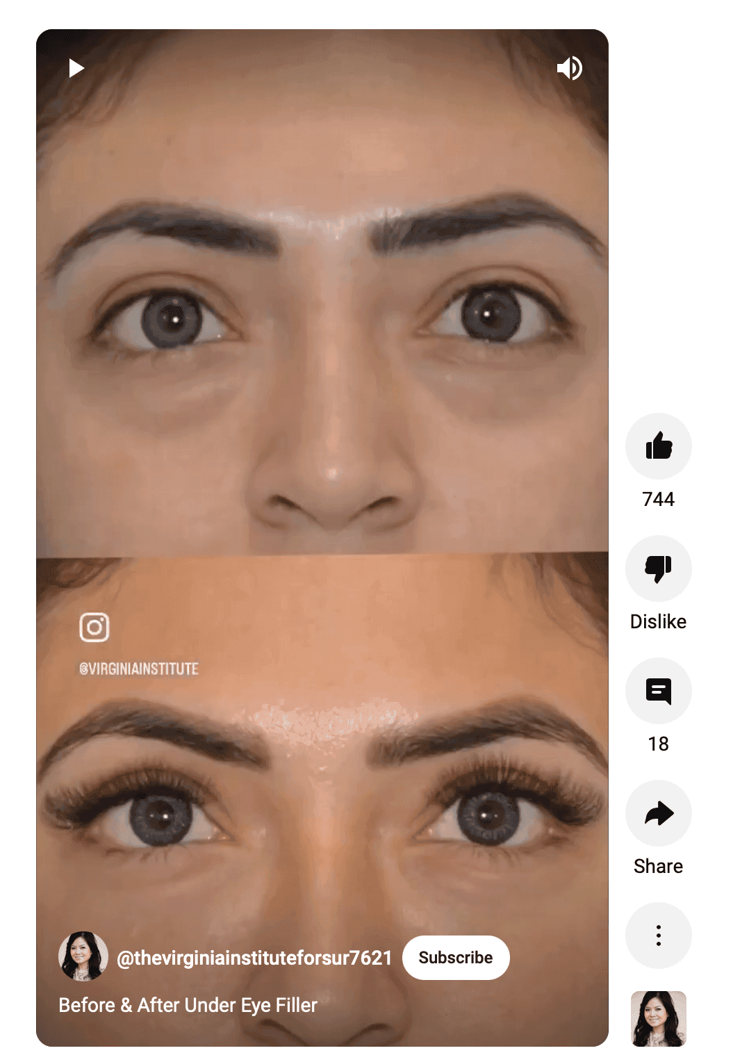 Close up of before and after eye filler
